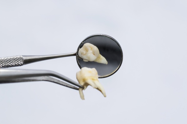 FAQs About Tooth Extractions