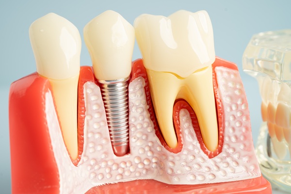 Can You Eat After Getting Tooth Implants?